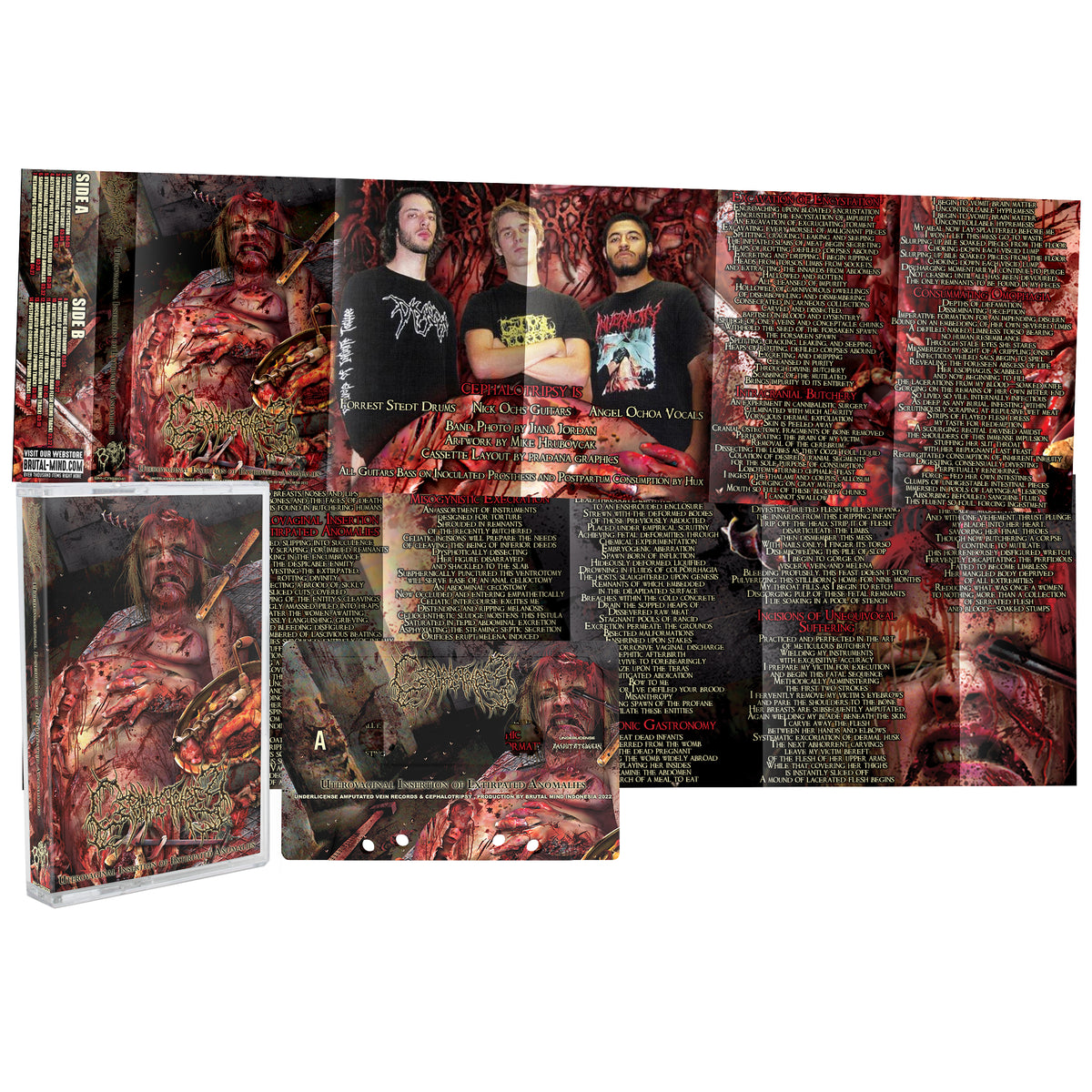 Cephalotripsy "Uterovaginal Insertion of Extirpated Anomalies " Cassette